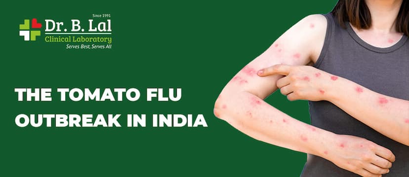 Signs and Symptoms of Tomato Flu in India