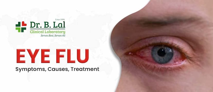 How to Cure Eye Flu? Symptoms, Causes and Treatment Options