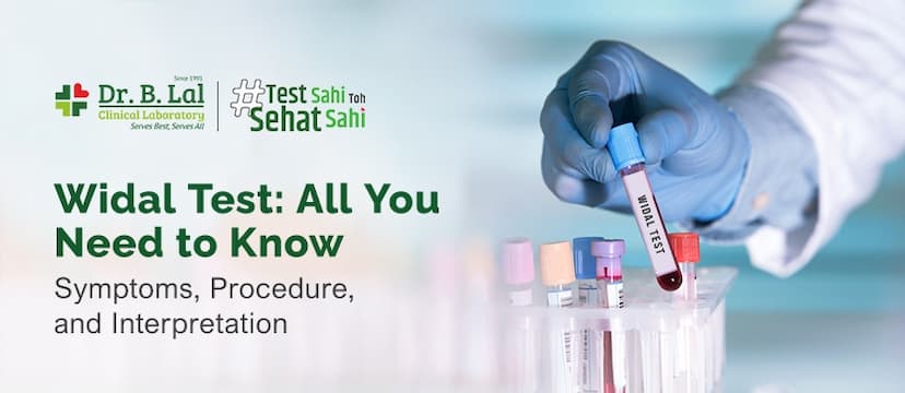 Widal Test: Purpose, Procedure & Result