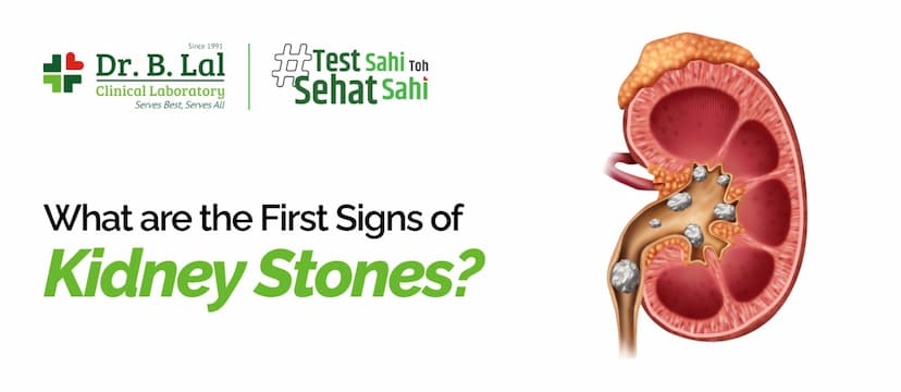 What are the First Signs of Kidney Stones?