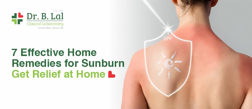  7 Effective Home Remedies for Sunburn - Get Relief at Home