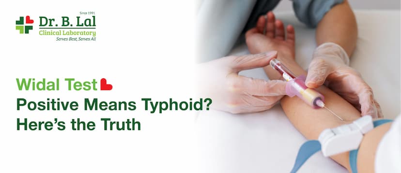 Widal Test Positive Means Typhoid? Here’s the Truth