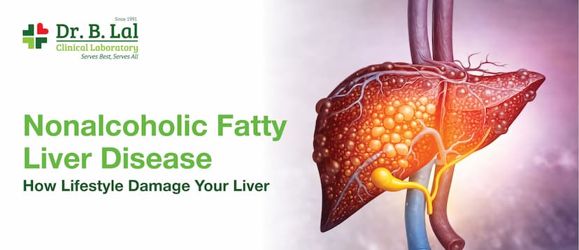 Nonalcoholic Fatty Liver Disease: How Lifestyle Is Quietly Damaging Your Liver